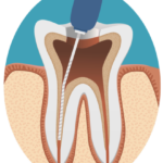 歯の神経の除去