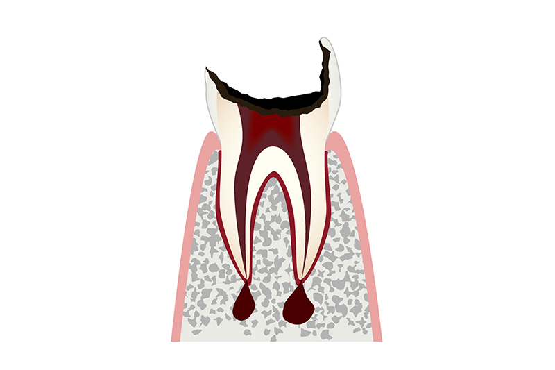 歯冠が大きく失われた歯